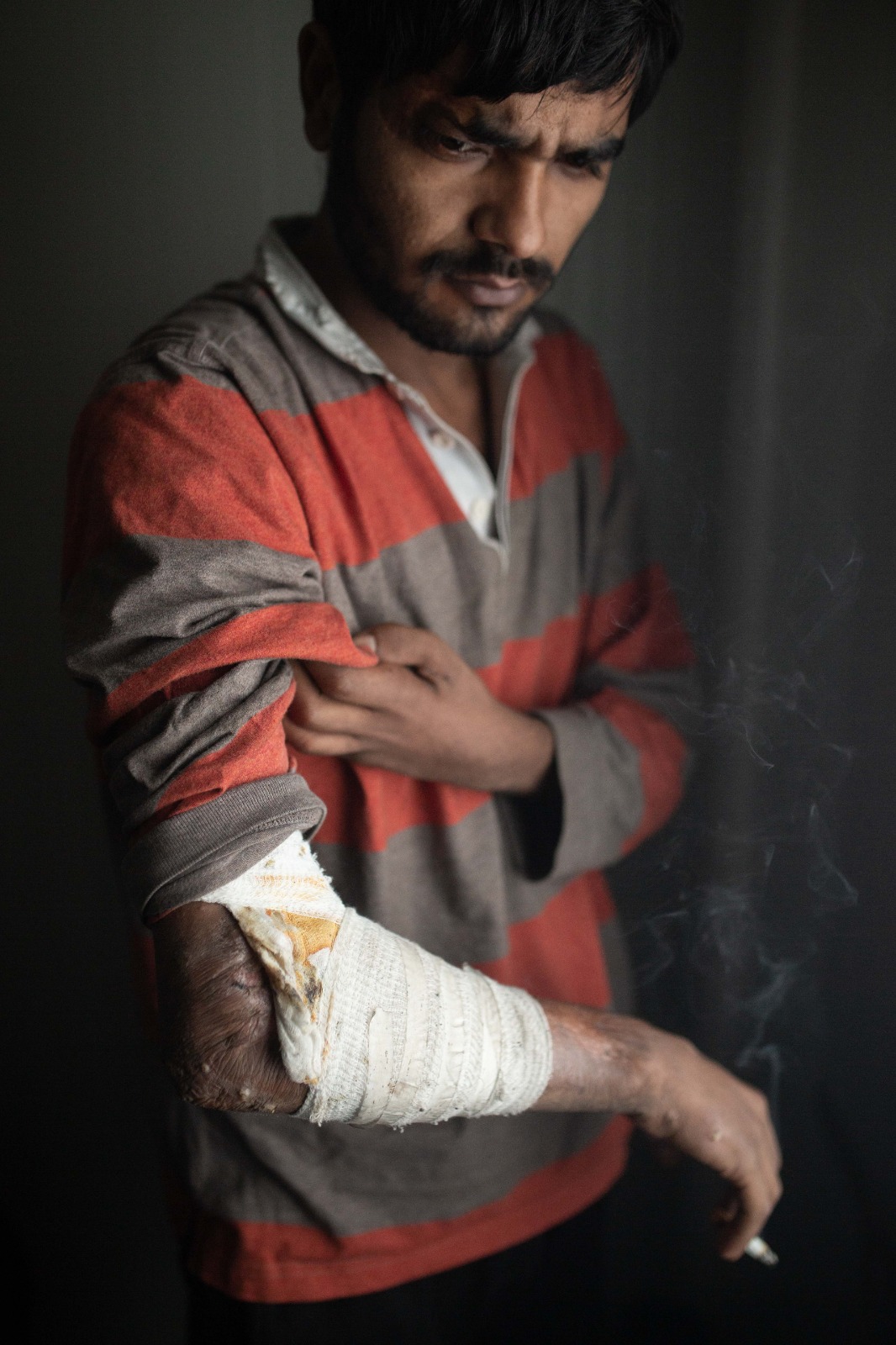 Ekram Sahel, 23 anni, del Pakistan, mostra le ferite causate dall'incendio che ha distrutto il campo di Lipa il 23 dicembre 2020. Credits: Valerio Muscella e Michele Lapini