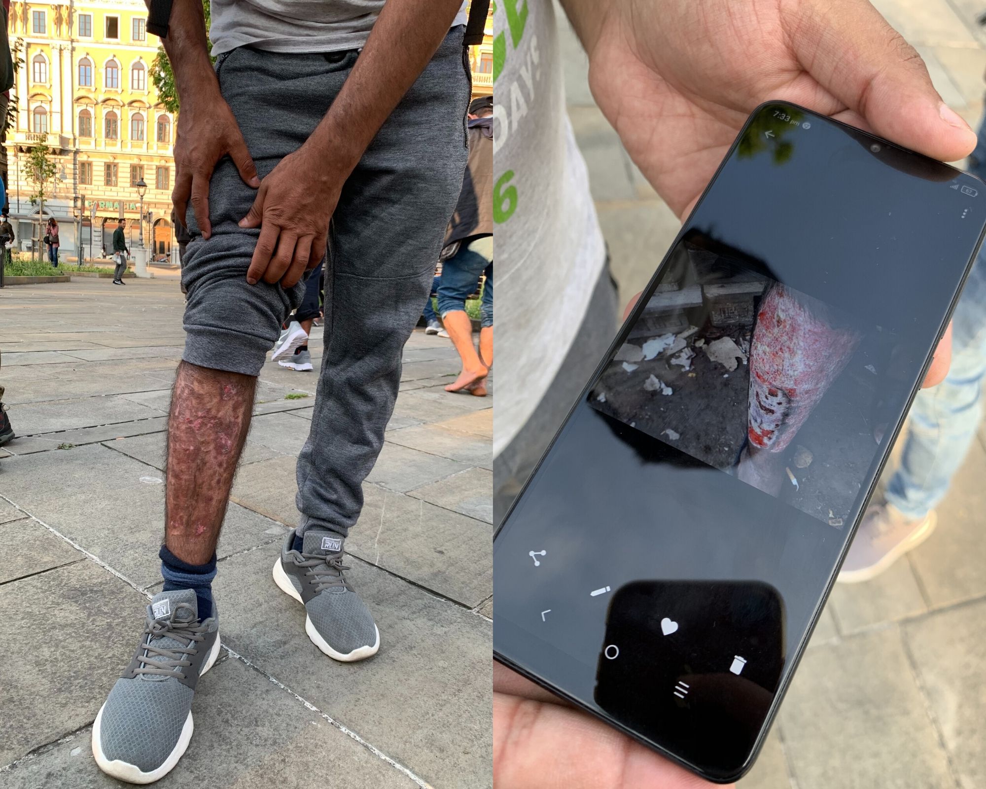 Umar, 24 anni, mostra i segni delle violenze subite dalla polizia croata. Credits: Rosita Rijtano